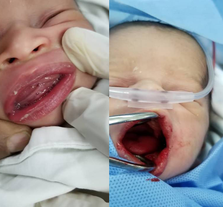 نُصح والده بالسفر للخارج لإجرائها له نظراً لصعوبتها.. نجاح عملية جراحية نوعية لرضيع لفك التصاق الفك العلوي مع السفلي