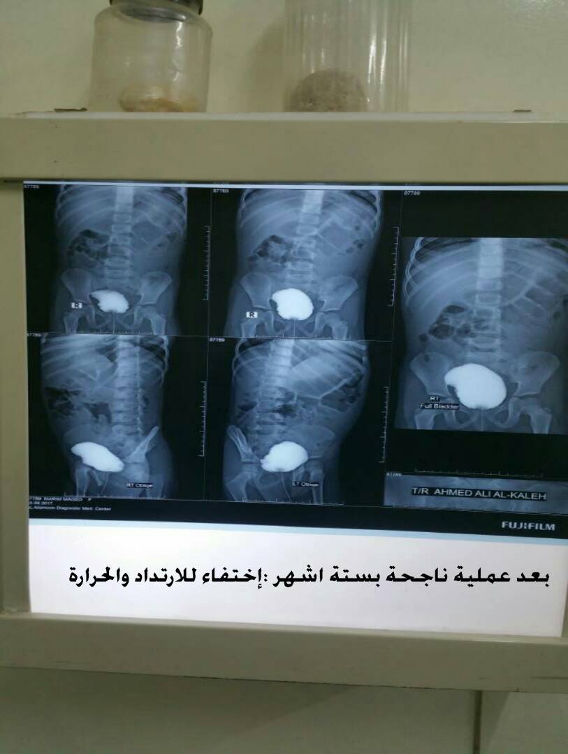 عملية زراعة حالب لطفلة تخلصها من معاناة الارتداد البولي